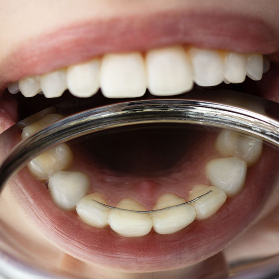 Bonded Orthodontic Retainers - Kenilworth | Shoreview Orthodontics